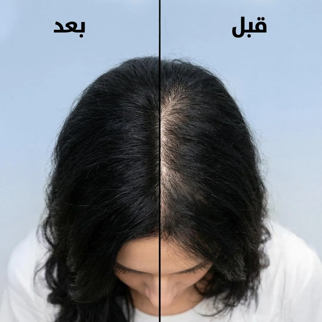 درمان ریزش مو