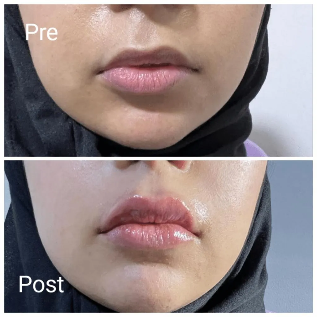 فیلر لب و چانه